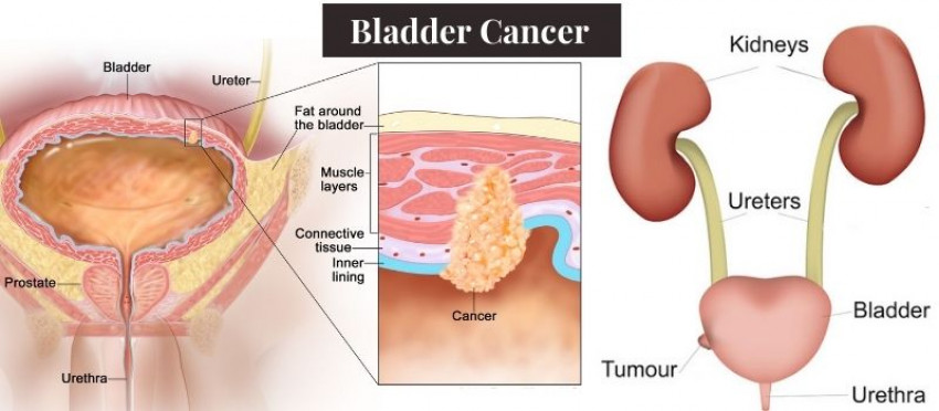 When To Consult An Uro-Oncosurgeon? Do All Cancers Require Surgeries?