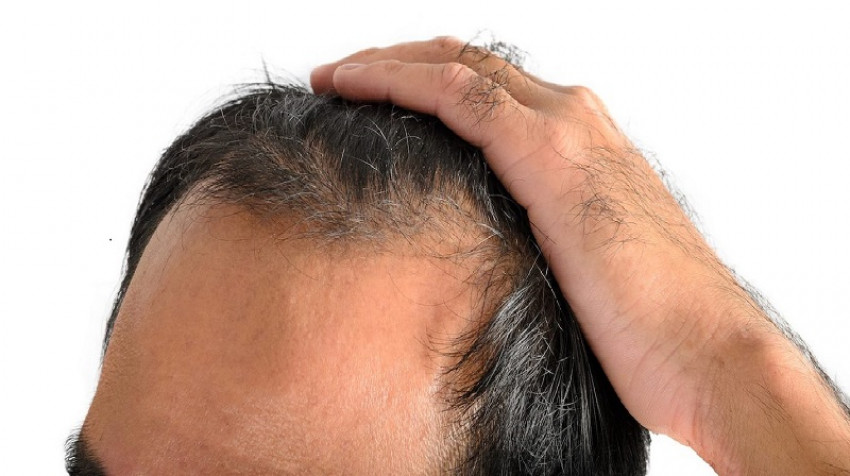 A Brief History of Hair Systems