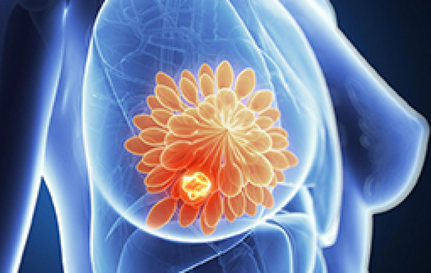 Best Hospital for breast cancer surgery in India
