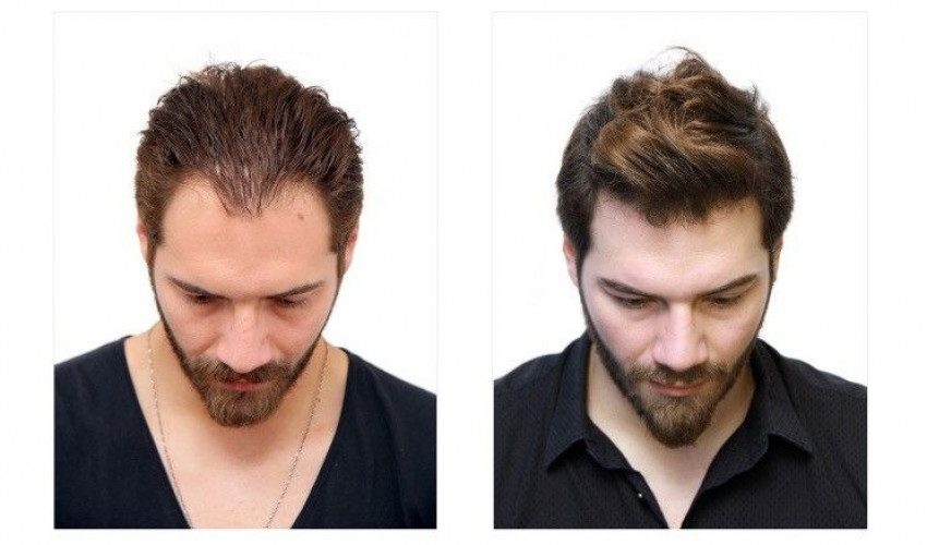 Hair Fall Treatment in Agra | Growup hair transplant