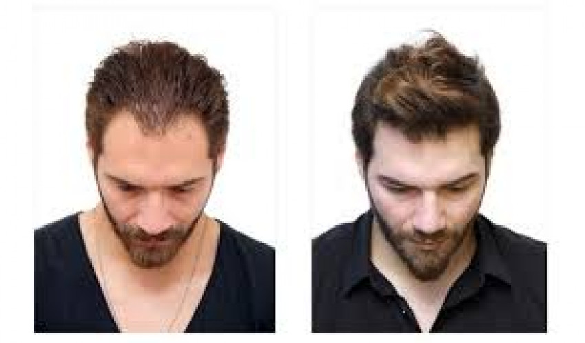 Who Is Surgeon Sanjay Kushwaha, The Best Hair Transplant Surgeon In Lucknow?