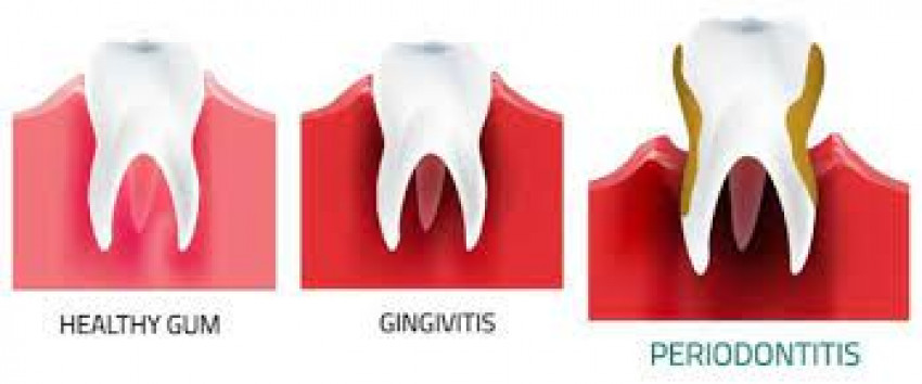 Dental Implants In Kansas City