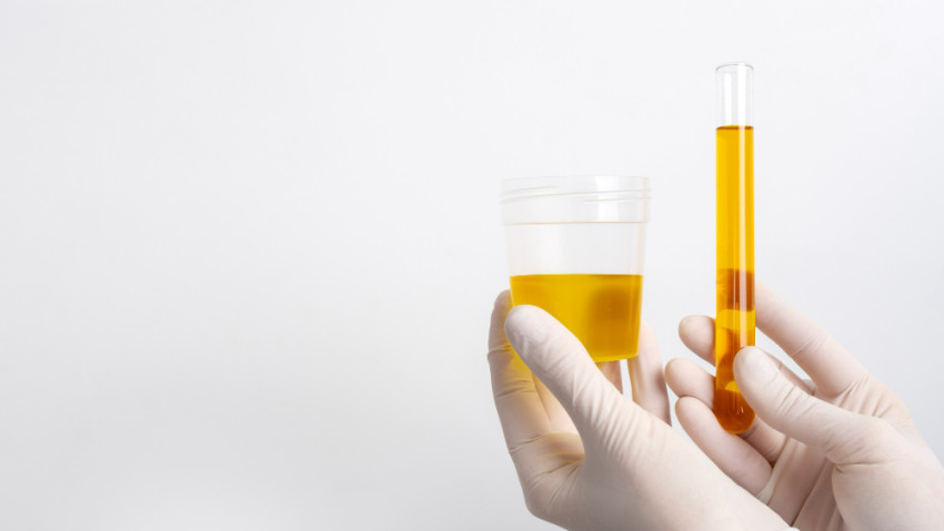 Foods To Avoid For Lowering Uric Acid: Your Guide To A Gout-Friendly Diet