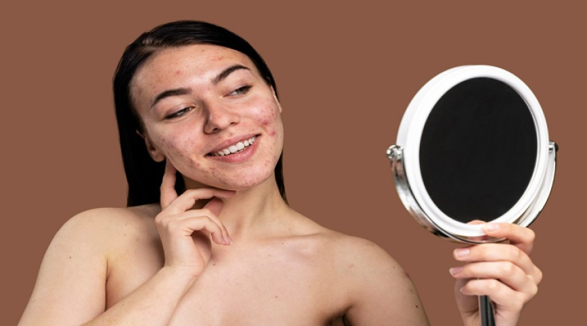 Enhance Your Acne Defense with a Control Facial Serum