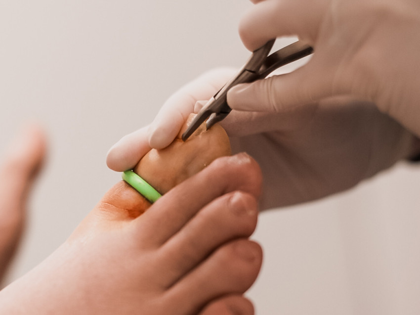 Where to Find Exceptional Partial Nail Removal Services in Scottsdale, AZ?