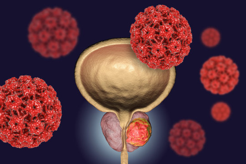 Nutritional Guidance For Bladder Cancer Patients