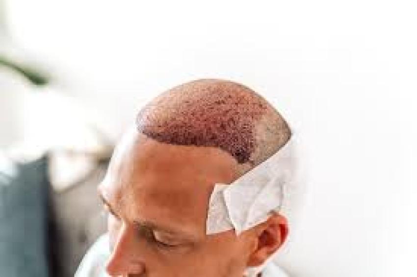 Hair Transplant in Dubai for International Patients: A Complete Guide