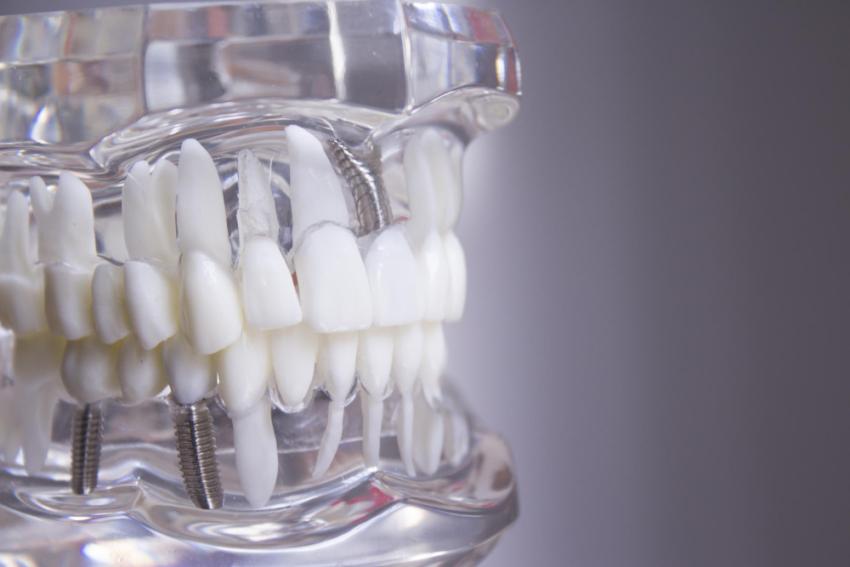 Are Multiple Implants Worth the Investment? Cost Vs Benefits