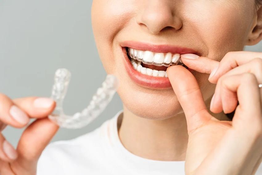 Can You Straighten Teeth Without Avoiding Your Favorite Foods?