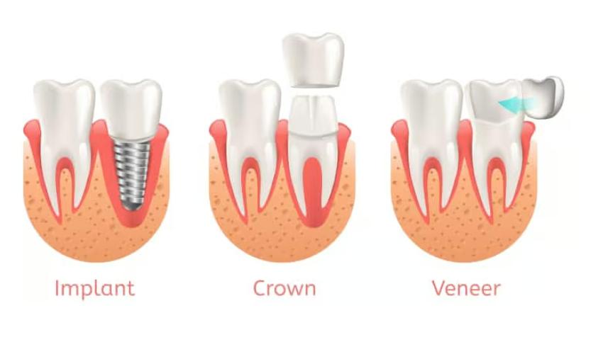 Same Day Crowns: The Future of Dental Care in Las Vegas