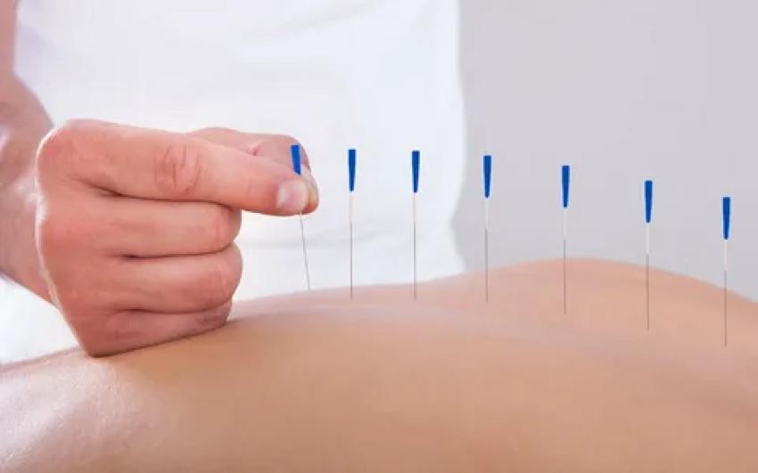 How Acupuncture Doctors Boost Fertility: What to Know