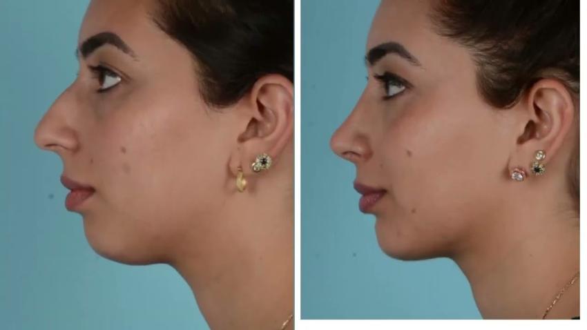How to ensure a quick recovery after chin reduction in Riyadh?