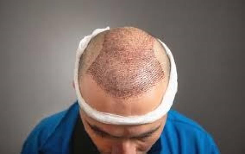 أحدث تقنيات زراعة الشعر في الرياض بنتائج فائقة الدقة