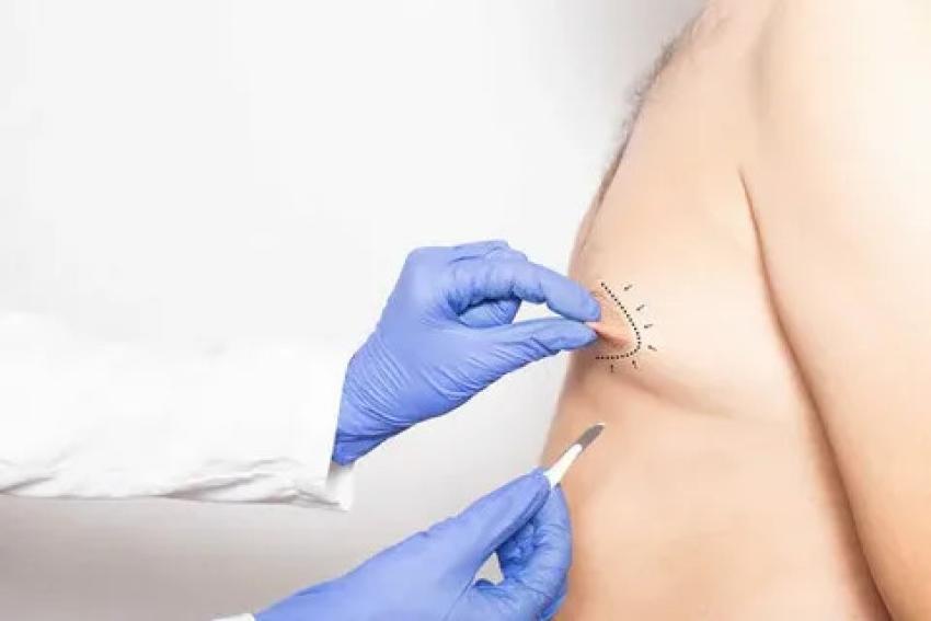 Gynecomastia in Islamabad: A Complete Medical Overview