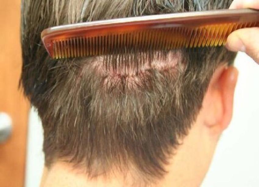 Bio-Enhanced Grafts: How Exosomes Are Changing Hair Transplant in Riyadh