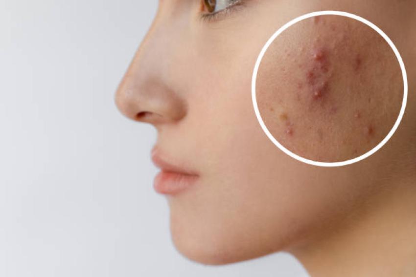 How to Try Skin Cycling for Acne Without Purging Forever
