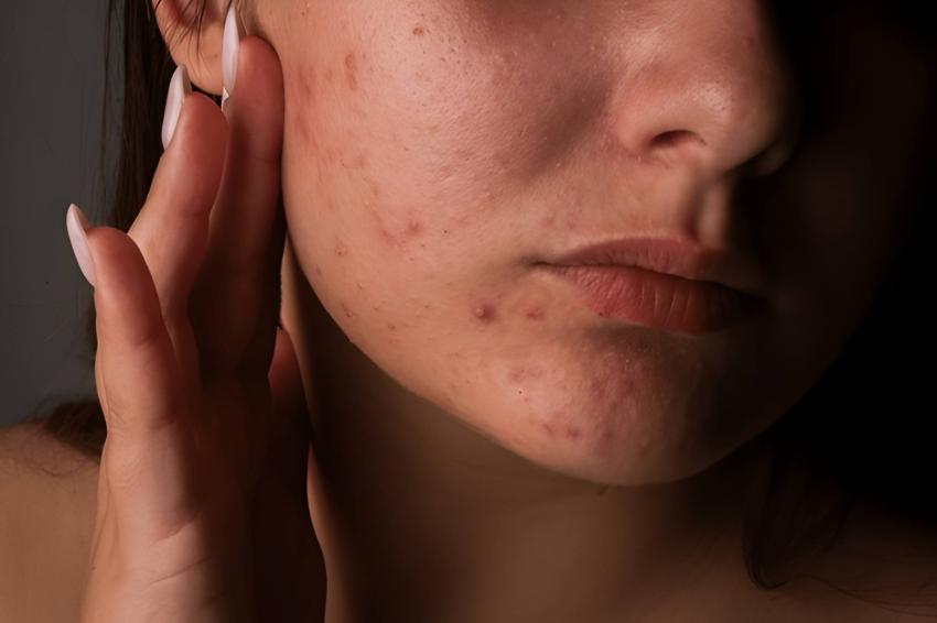 The Ultimate Guide to Effective Skincare for Acne-Prone Skin