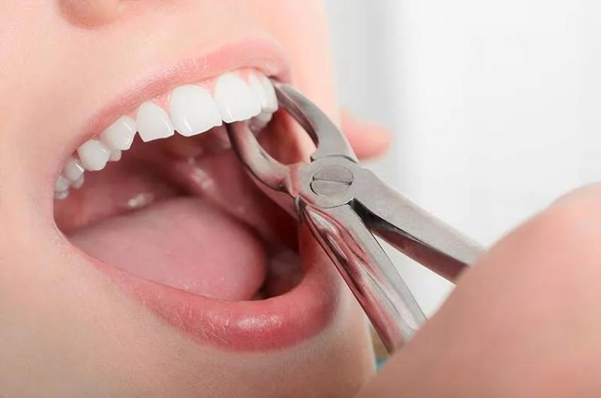 Tooth Extraction: When You Need It and What to Expect