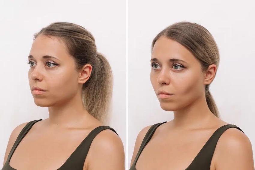 Exclusive Buccal Fat Removal in Islamabad Services