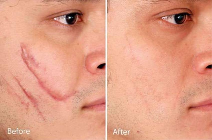 Scar removal in Dubai: Advanced Skin Resurfacing