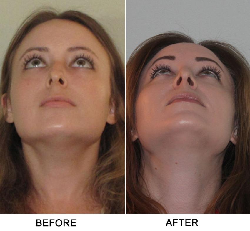 Septoplasty and Turbinate Reduction in Dubai: Surgery Guide