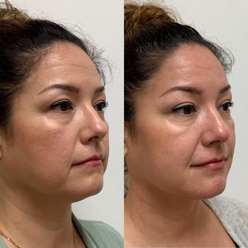 The Benefits of Silhouette Soft Thread Lift in Dubai