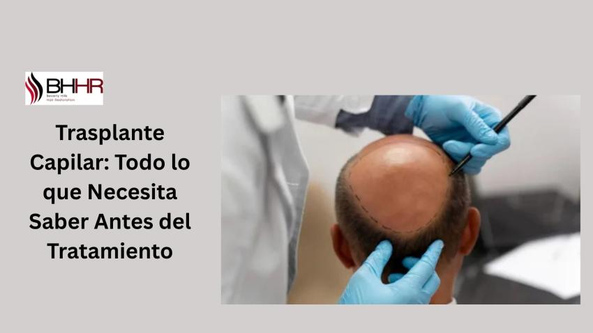 Trasplante Capilar: Todo lo que Necesita Saber Antes del Tratamiento