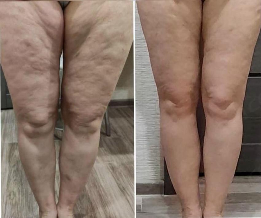 Aqualyx Injections: A Non-Surgical Solution for Stubborn Fat