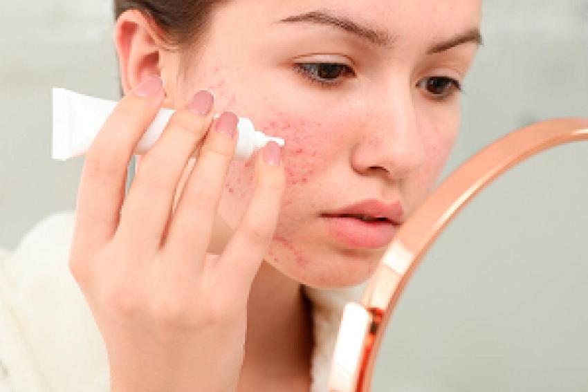 Expert Pimples Treatment in Dubai for Radiant Skin