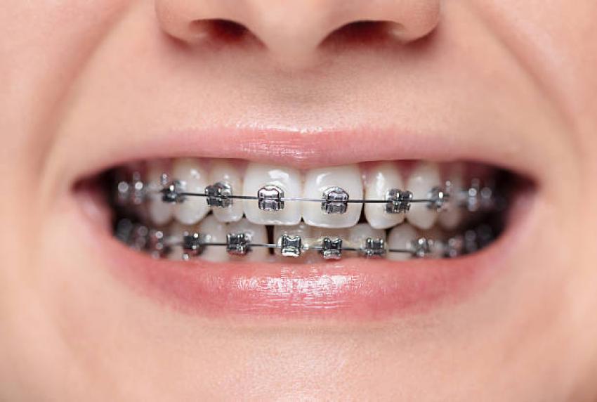 Achieve a perfect smile with advanced adult braces treatment