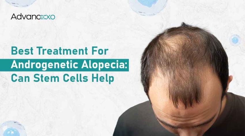 Best Treatment for Androgenetic Alopecia: Can Stem Cells Help