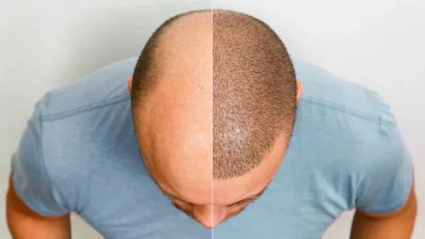 Crown Hair Transplant in Dubai: Restoring the Crown