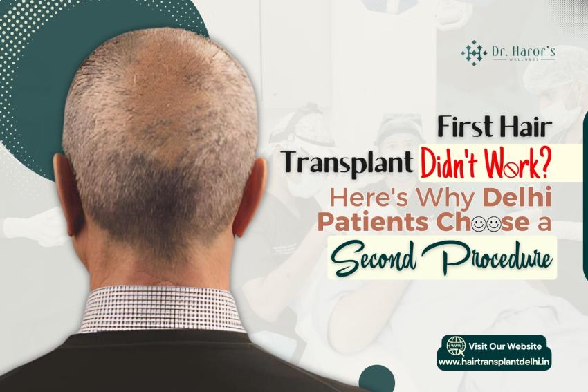 Bad Hair Transplant Results? Here's What Delhi Patients Try Next