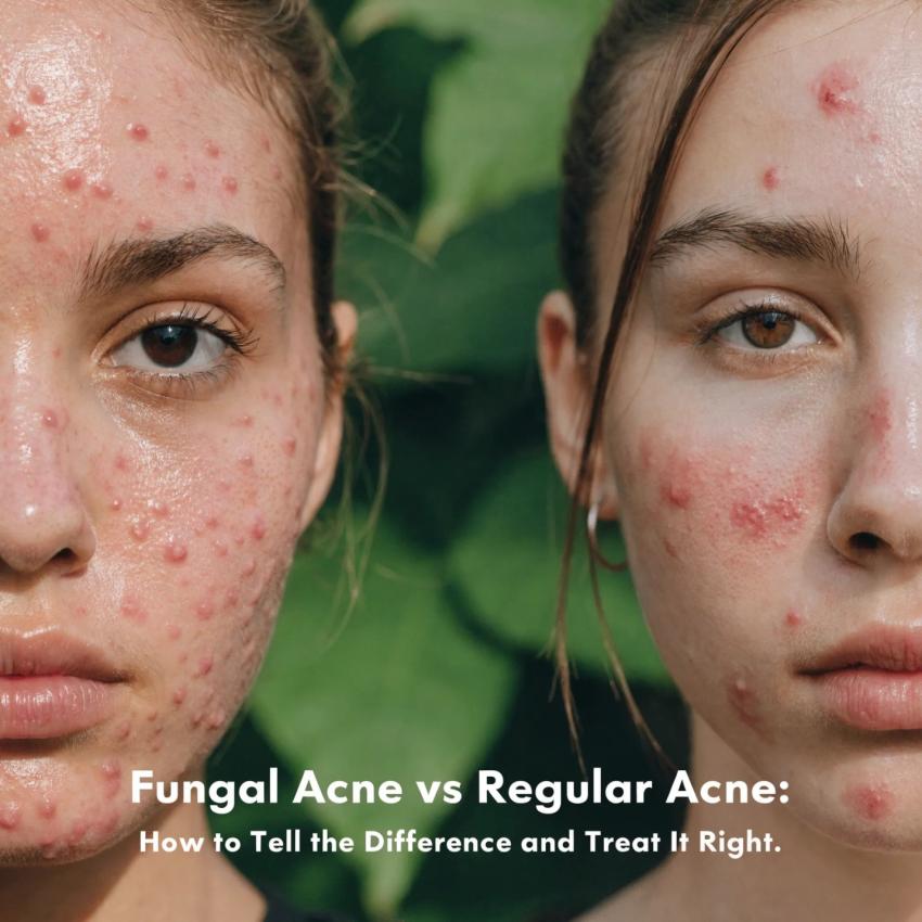 Fungal Acne vs Regular Acne: How to Tell the Difference and Treat It Right.