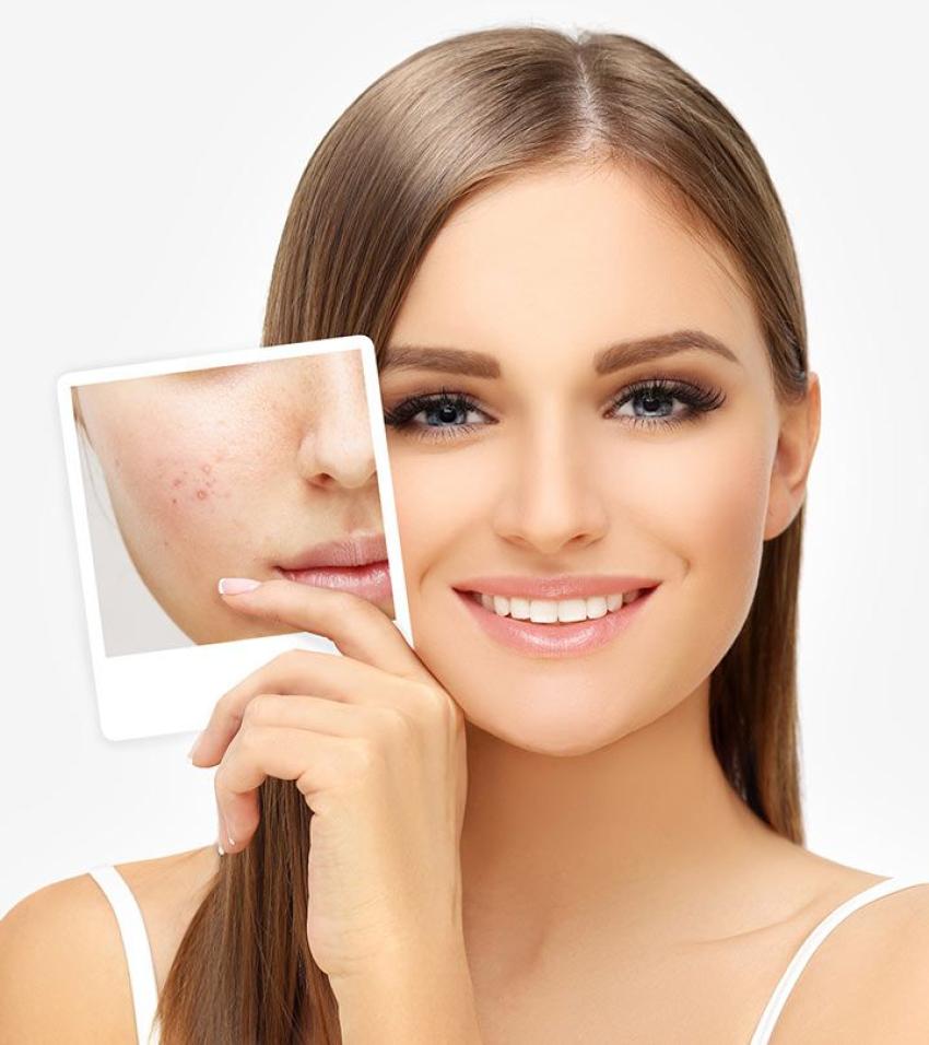 Pimples Treatment in Dubai: Modern Paths to Clear Skin