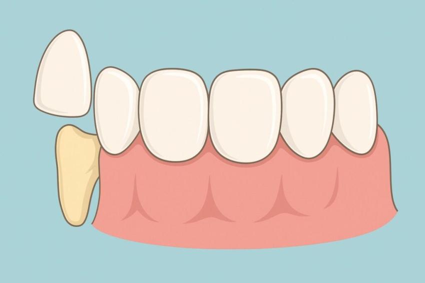 How Dental Veneers Can Transform Your Smile: A Complete Patient Guide