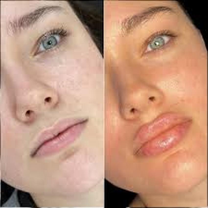 سر البشرة المتوهجة والمشرقة باستخدام حشوات الجلدية في دبي لدى عيادة تجميل دبي