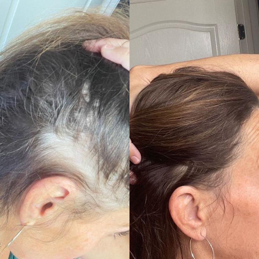 Hair Transplant in Dubai: Reclaiming Your Natural Hairline