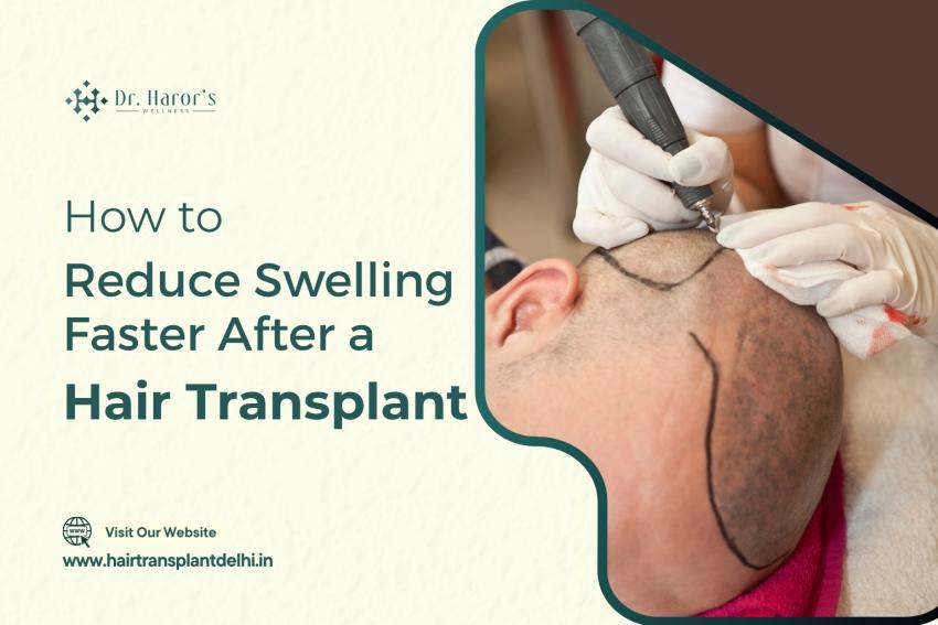 How to Reduce Swelling Faster After a Hair Transplant